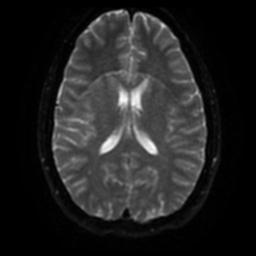 Cerebellar hemangioblastoma (Radiopaedia 29570-30077 Axial DWI 42).jpg
