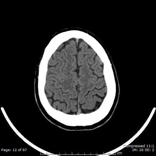 Cerebellar hemangioblastoma (Radiopaedia 52360-58258 Axial non-contrast 12).jpg