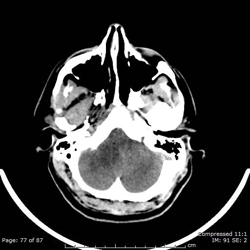 Cerebellar hemangioblastoma (Radiopaedia 52360-58258 Axial non-contrast 77).jpg