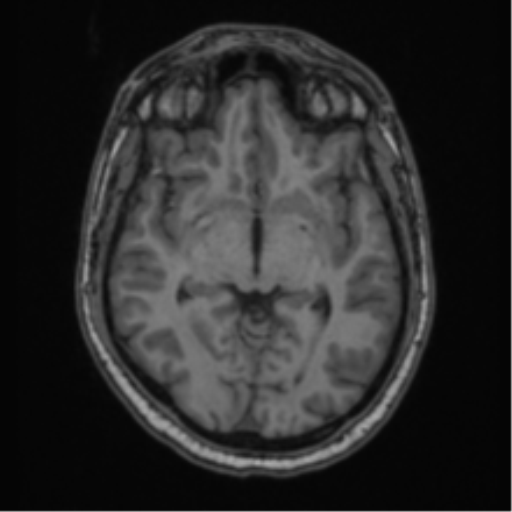 Cerebellar hemangioblastomas and pituitary adenoma (Radiopaedia 85490-101176 Axial T1 34).png