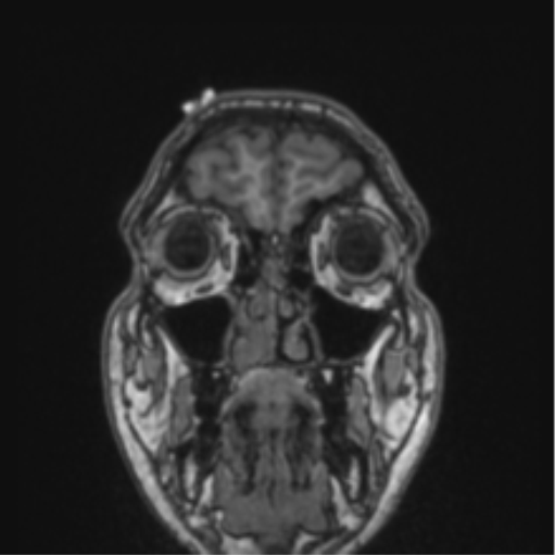 Cerebellar hemangioblastomas and pituitary adenoma (Radiopaedia 85490-101176 Coronal T1 79).png
