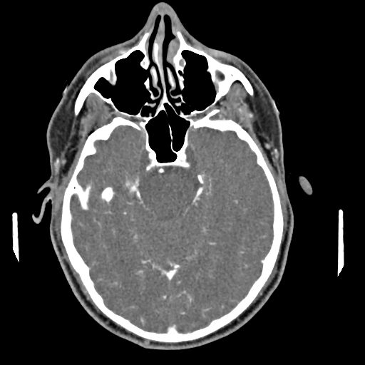 Cerebellar infarct due to vertebral artery dissection with posterior fossa decompression (Radiopaedia 82779-97029 C 1).png