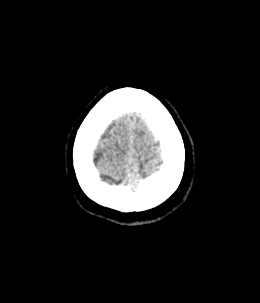 Cerebellar metastases - colorectal adenocarcinoma (Radiopaedia 40947-43652 Axial non-contrast 63).png