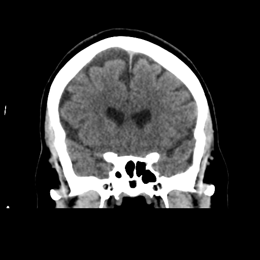 Cerebellar metastasis (cystic appearance) (Radiopaedia 41395-44258 Coronal non-contrast 24).png