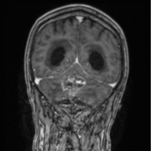 Cerebellar metastasis from lung adenocarcinoma (Radiopaedia 86690-102829 Coronal T1 C+ 30).png