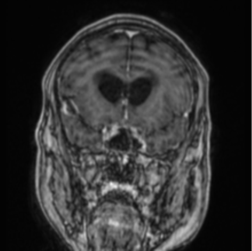 Cerebellar metastasis from lung adenocarcinoma (Radiopaedia 86690-102829 Coronal T1 C+ 67).png