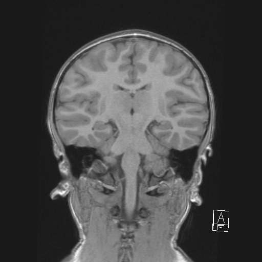 Cerebellar stroke (Radiopaedia 32202-33150 Coronal T1 34).png