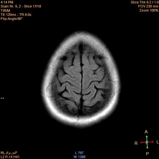 File:Cerebellopontine angle meningioma (Radiopaedia 22488-22525 Axial FLAIR 16).jpg