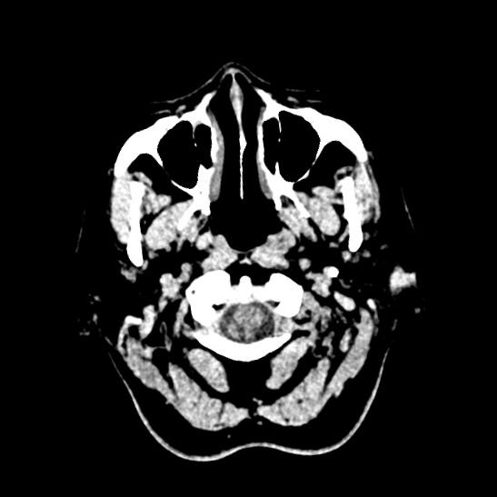 Cerebellopontine angle meningioma (Radiopaedia 53561-59592 Axial non-contrast 3).jpg