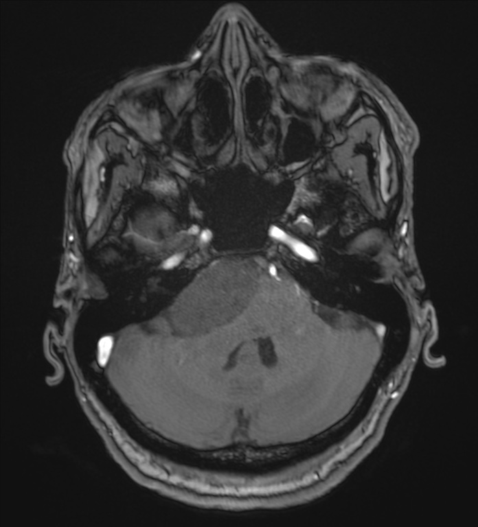 Cerebellopontine angle meningioma (Radiopaedia 72983-83680 Axial MRA 25).jpg