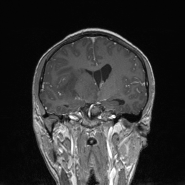 File:Cerebral abscess (Radiopaedia 24212-24478 Coronal T1 C+ 107).jpg