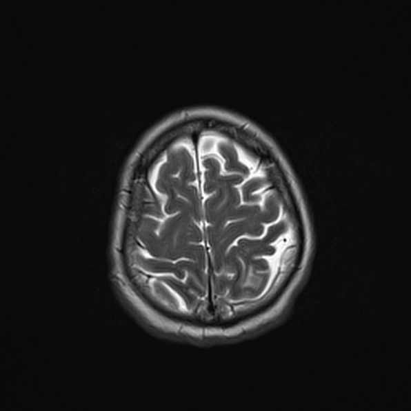 Cerebral abscess (Radiopaedia 26111-26247 Axial T2 50).jpg