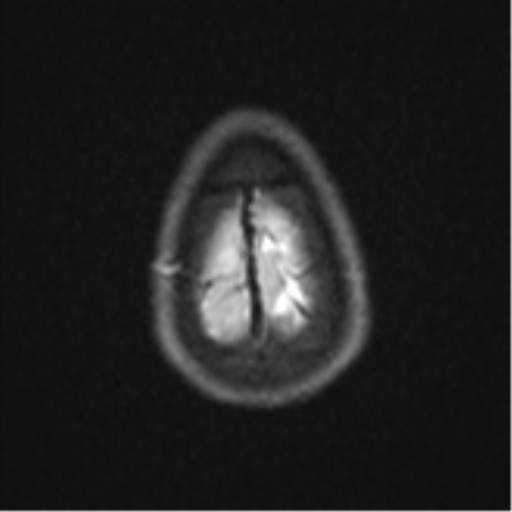 File:Cerebral abscess (Radiopaedia 60342-68009 Axial DWI 34).png