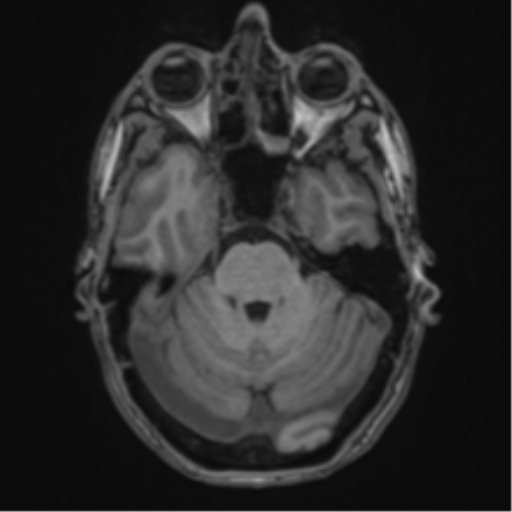 File:Cerebral abscess (Radiopaedia 60342-68009 Axial T1 11).png