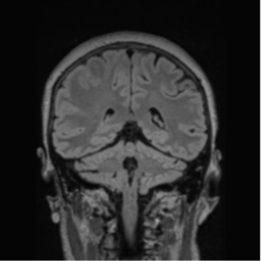 Cerebral abscess from pulmonary arteriovenous malformation (Radiopaedia 86275-102291 Coronal FLAIR 34).png