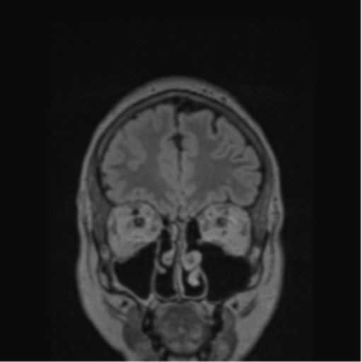 Cerebral abscess from pulmonary arteriovenous malformation (Radiopaedia 86275-102291 Coronal FLAIR 72).png
