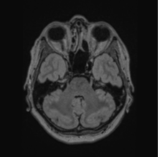 Cerebral abscess from pulmonary arteriovenous malformation (Radiopaedia 86275-102291 J 23).png
