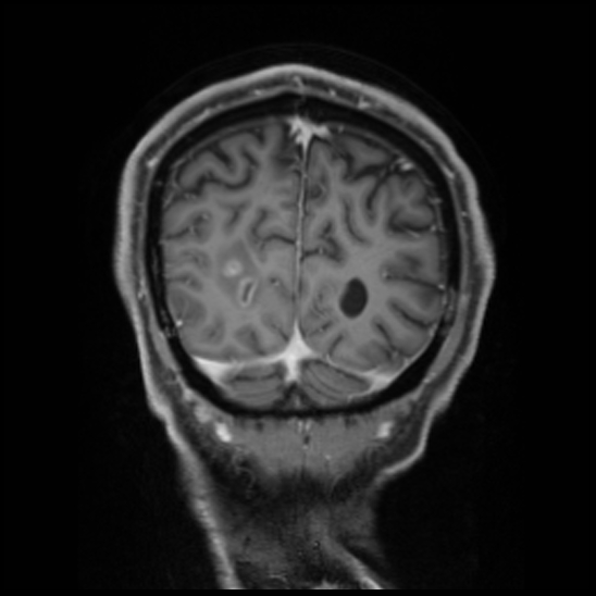 Cerebral abscess with ventriculitis (Radiopaedia 78965-91878 Coronal T1 C+ 54).jpg