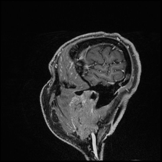 Cerebral abscess with ventriculitis (Radiopaedia 78965-91878 Sagittal T1 C+ 160).jpg
