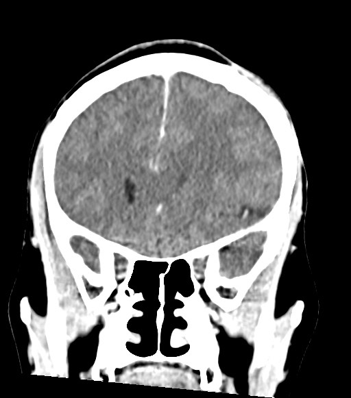 Cerebral abscesses (Radiopaedia 70458-80568 Coronal Contrast 23).jpg