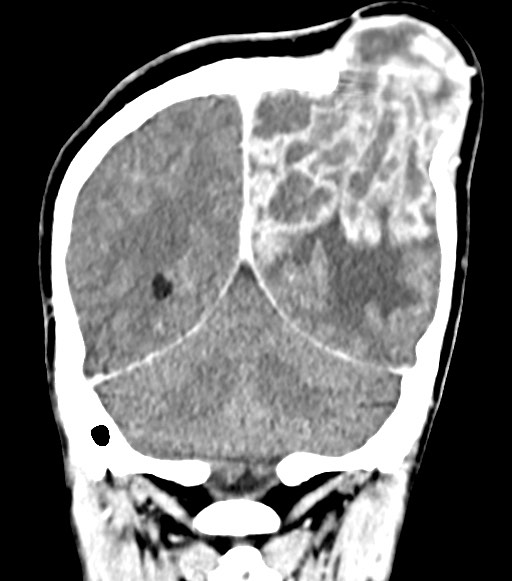 Cerebral abscesses (Radiopaedia 70458-80568 Coronal Contrast 50).jpg
