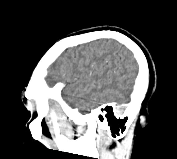 Cerebral abscesses (Radiopaedia 70458-80568 Sagittal Contrast 45).jpg