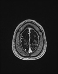 Cerebral amyloid angiopathy-related inflammation (Radiopaedia 58270-65377 Axial T1 C+ fat sat 140).jpg