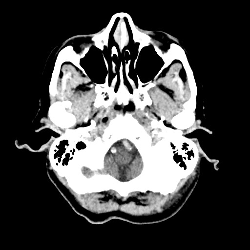 File:Cerebral amyloid angiopathy-related inflammation (Radiopaedia 74836-85848 Axial non-contrast 10).jpg
