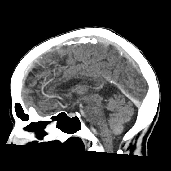 Cerebral amyloid angiopathy-related inflammation (Radiopaedia 74836-85848 C 30).jpg