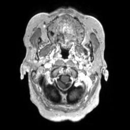 Cerebral amyloid angiopathy (Radiopaedia 29129-29518 Axial T1 C+ 18).jpg