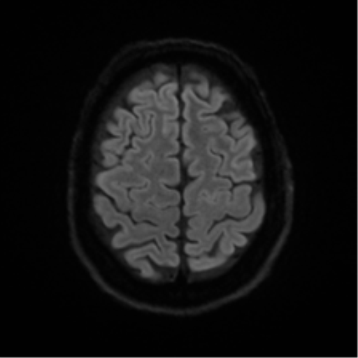 Cerebral amyloid angiopathy (Radiopaedia 46082-50433 Axial DWI 49).png