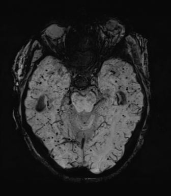 File:Cerebral amyloid angiopathy (Radiopaedia 46082-50433 Axial SWI MIP 26).png