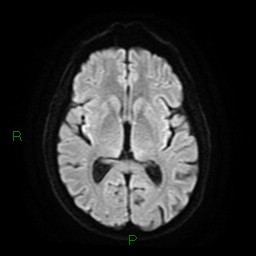Cerebral amyloid angiopathy (Radiopaedia 77506-89664 Axial DWI 15).jpg