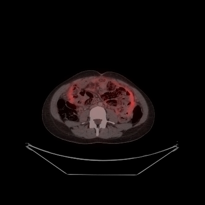 Cerebral and abdominal tuberculosis (Radiopaedia 90499-107853 C 183).jpg