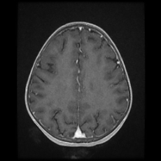 Cerebral and spinal tuberculosis (Radiopaedia 90489-107837 Axial T1 C+ 134).jpg