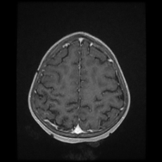 Cerebral and spinal tuberculosis (Radiopaedia 90489-107837 Axial T1 C+ 154).jpg