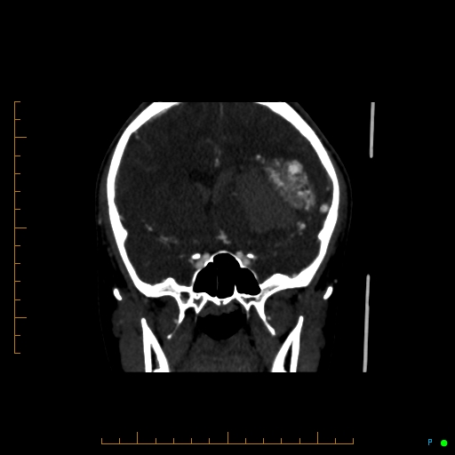 Cerebral arteriovenous malformation (AVM) (Radiopaedia 78162-90706 Coronal CTA 64).jpg