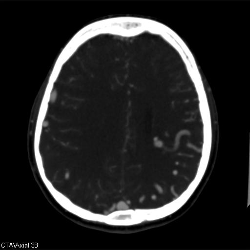 Cerebral arteriovenous malformation (Radiopaedia 28518-28759 B 38).jpg