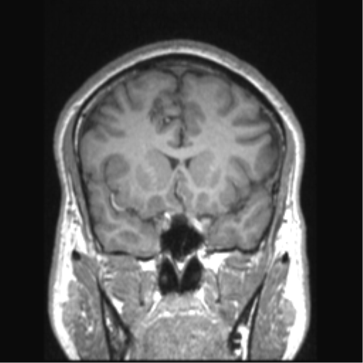 File:Cerebral arteriovenous malformation (Radiopaedia 39259-41506 Coronal T1 61).png