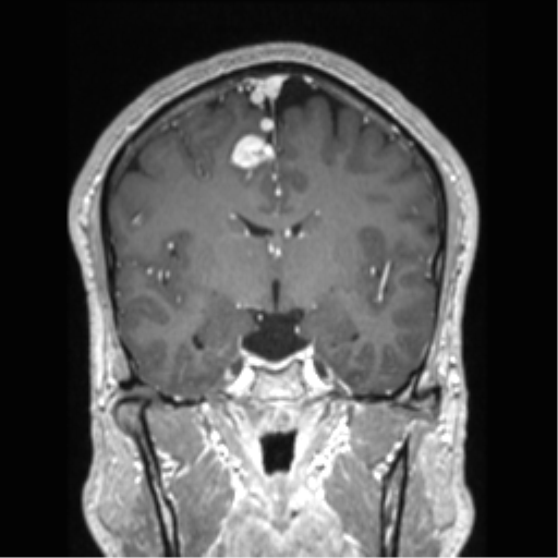 Cerebral arteriovenous malformation (Radiopaedia 39259-41506 Coronal T1 C+ 52).png