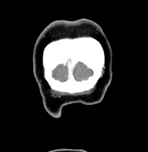 Cerebral arteriovenous malformation (Radiopaedia 73830-84645 C 95).jpg