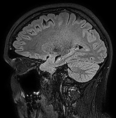 Cerebral arteriovenous malformation (Radiopaedia 74411-85654 Sagittal FLAIR 40).jpg