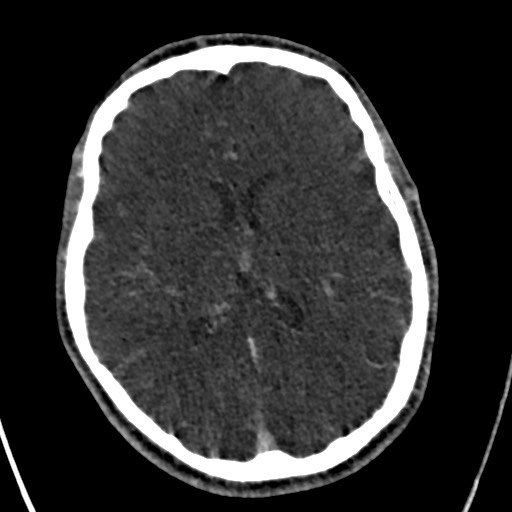 Cerebral arteriovenous malformation (Radiopaedia 78188-90746 Axial C+ delayed 100).jpg