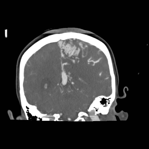 File:Cerebral arteriovenous malformation (Radiopaedia 79677-92888 B 30).jpg