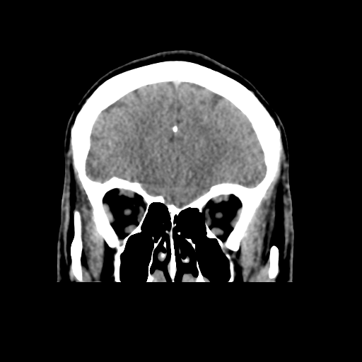 Cerebral arteriovenous malformation (Spetzler-Martin grade 2) (Radiopaedia 41262-44076 Coronal non-contrast 14).png