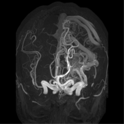 File:Cerebral arteriovenous malformation - huge (Radiopaedia 35734-37272 MRA 17).png