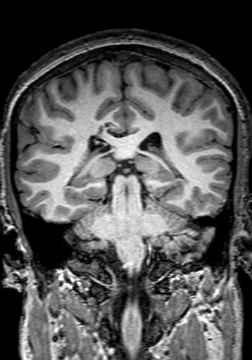 Cerebral arteriovenous malformation at posterior body of corpus callosum (Radiopaedia 74111-84925 Coronal T1 211).jpg