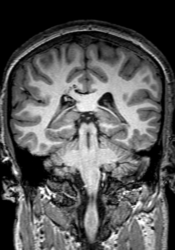 File:Cerebral arteriovenous malformation at posterior body of corpus callosum (Radiopaedia 74111-84925 Coronal T1 214).jpg