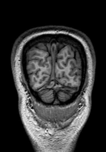 Cerebral arteriovenous malformation at posterior body of corpus callosum (Radiopaedia 74111-84925 Coronal T1 326).jpg