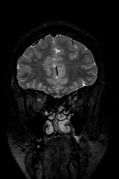 Cerebral arteriovenous malformation at posterior body of corpus callosum (Radiopaedia 74111-84925 Coronal T2 34).jpg